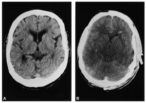 Edema cerebral en hiponatremia aguda